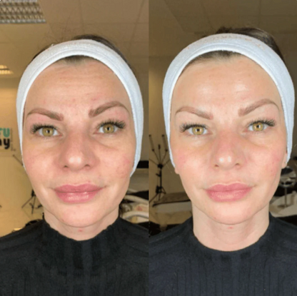 Fiorenza™ Mascarilla Boost De Colageno